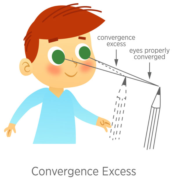 Eye Teaming (Convergence) Eyecare Kids