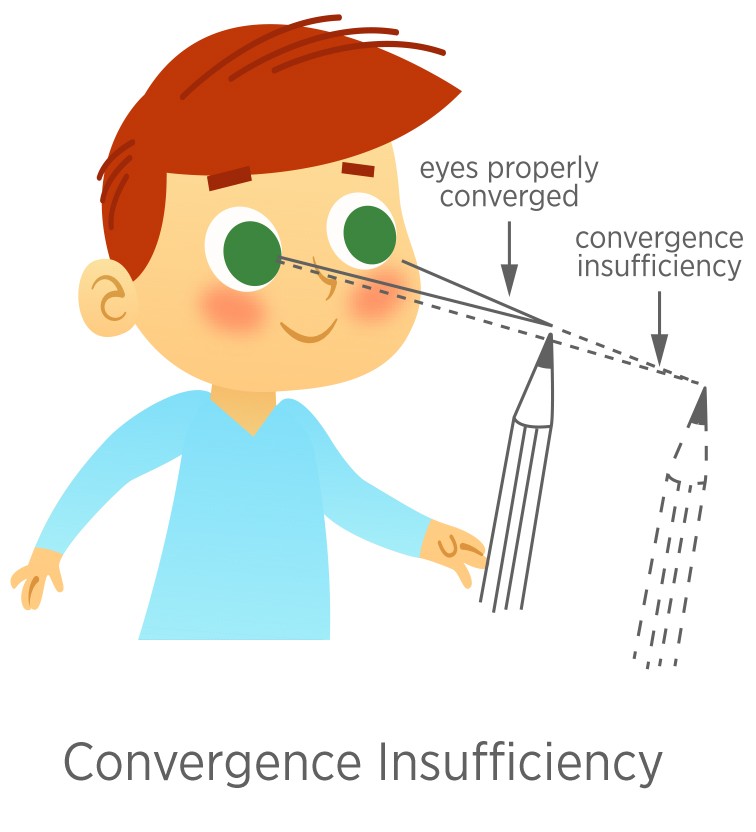 Eye Teaming (Convergence) - Eyecare Kids