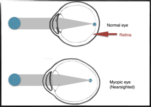 Image 2: Normal eye vs. Myopic eye (Short-sighted)