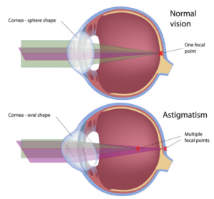 Image 4: Normal vision vs. Astigmatism
