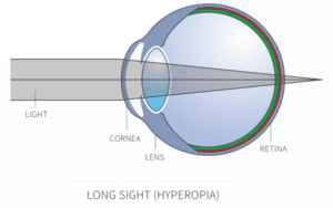 Image 3: Hyperopic eye (Long-sighted)