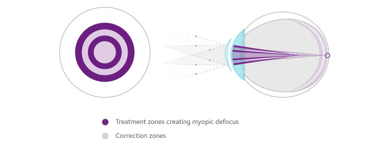 MiSight 1 day with ActivControl™ Technology helps slow the elongation of the eye and myopia progression, while fully correcting refractive error. Addressing axial elongation helps to reduce the risk of myopia-related vision complications later in life, including irreversible vision loss.