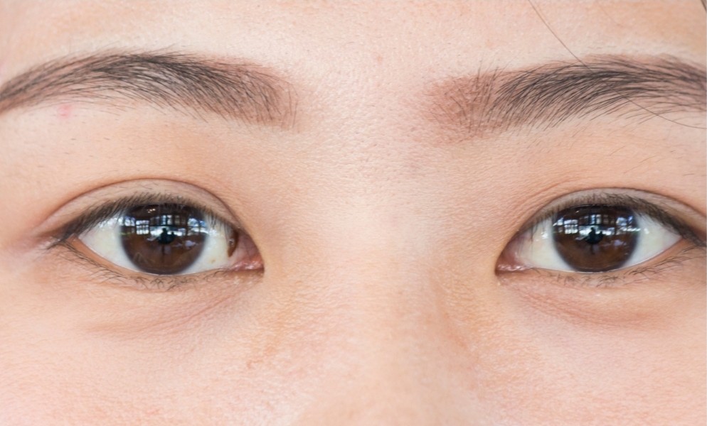 Preventing Stye Recurrence Stye treatment - Find a Behavioural Optometrist for Your Child in ...